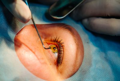 The operation on the eye. Cataract surgery. Vision correction. Selective focus. Cropped shot of an eye.
